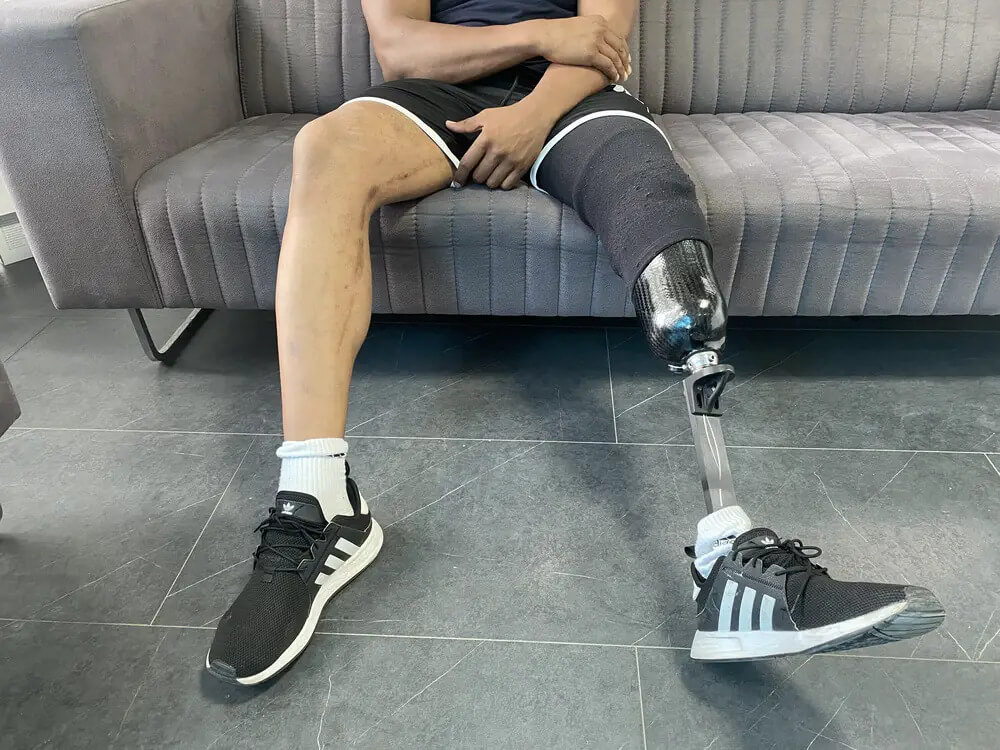 Transtibial Prosthesis Guide for New Amputees